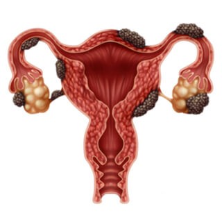 Endometriose