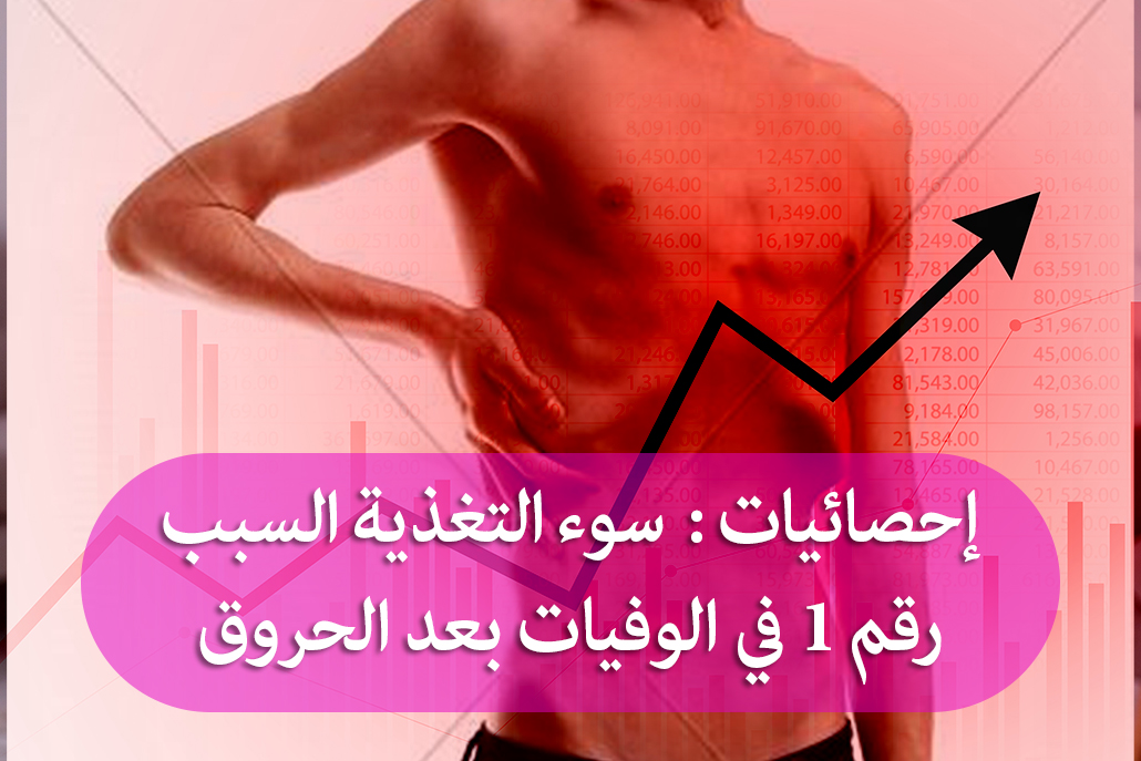 إحصائيات: سوء التغذية السبب رقم 1 في الوفيات بعد الحروق